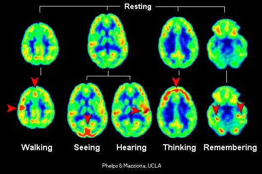 pet scan of brain sonus complete review